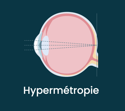 Hypermétropie